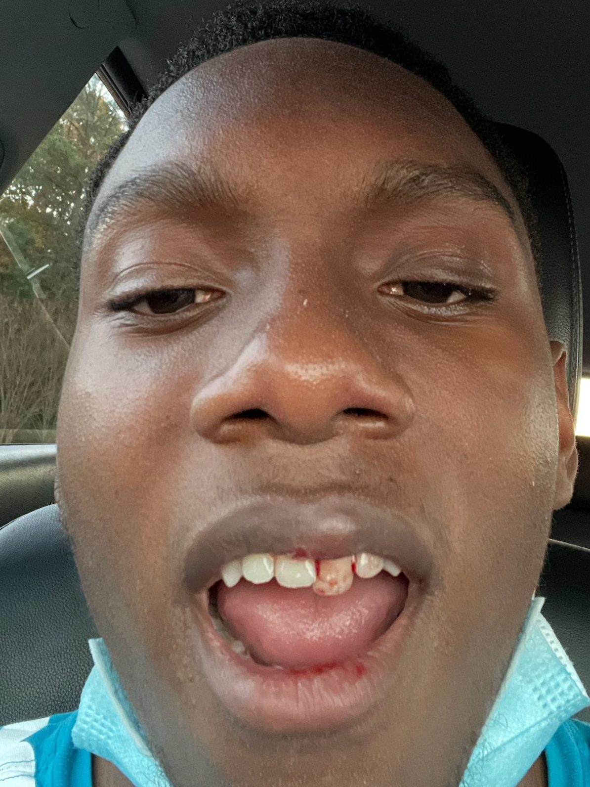 Young person showing dental injury with blood on teeth, indicating a dental emergency, highlighting the need for immediate care and treatment at Evolve Dental Care.